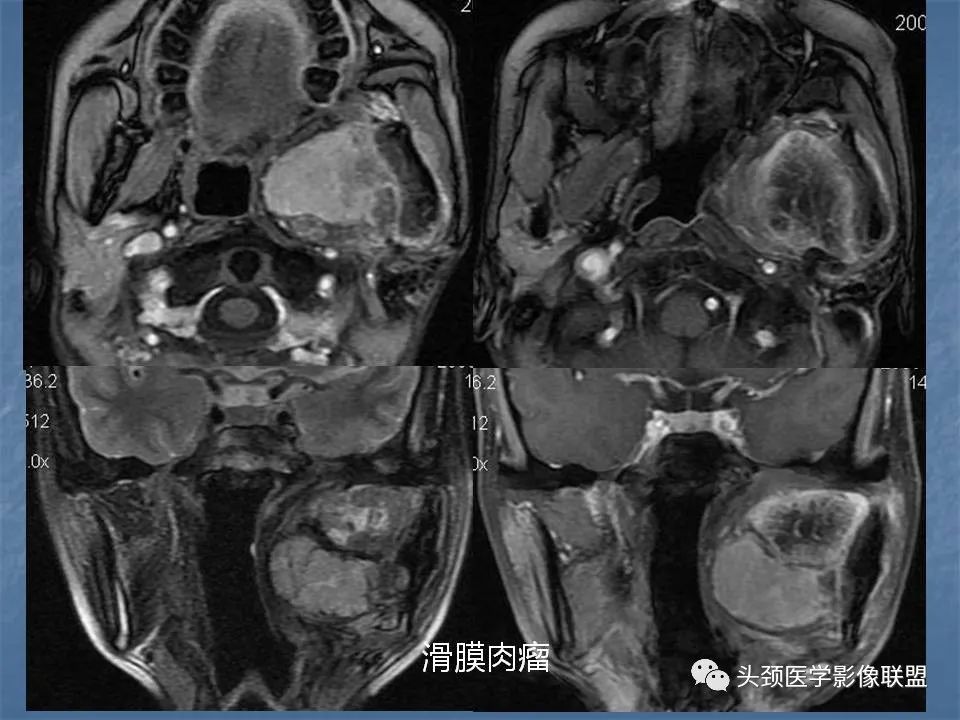 影像PPT - 【PPT】咽旁间隙与咽旁肿瘤的影像诊断-53