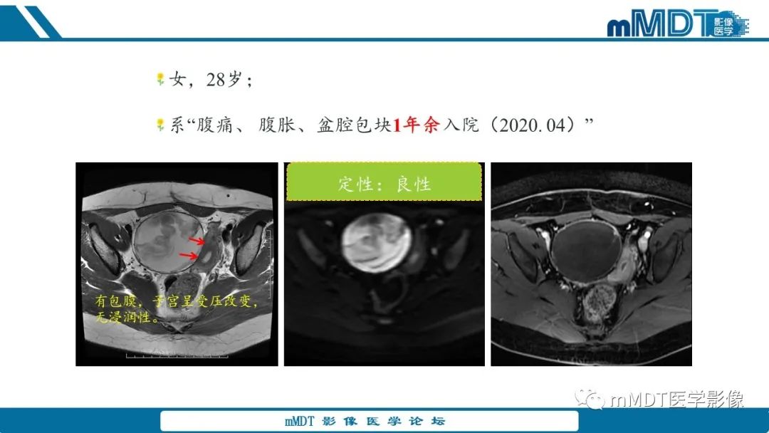 影像PPT - 【病例】盆腔纱布瘤1例MR影像解析-14