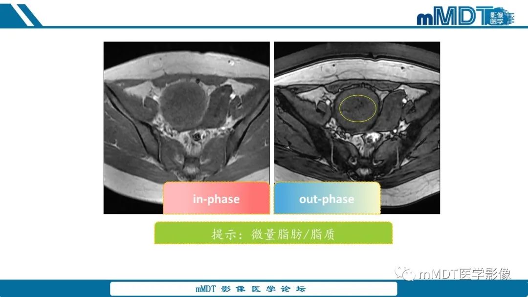 影像PPT - 【病例】盆腔纱布瘤1例MR影像解析-15