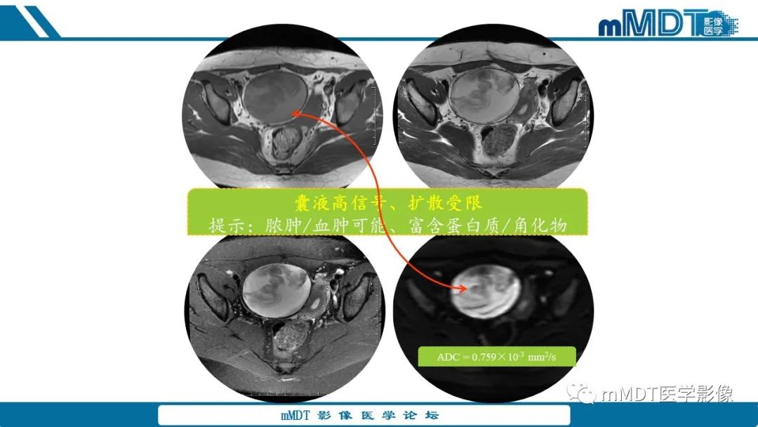 影像PPT - 【病例】盆腔纱布瘤1例MR影像解析-16