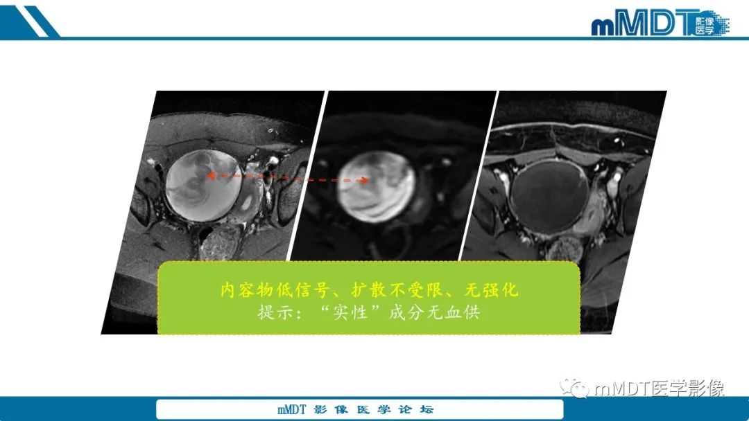 影像PPT - 【病例】盆腔纱布瘤1例MR影像解析-17
