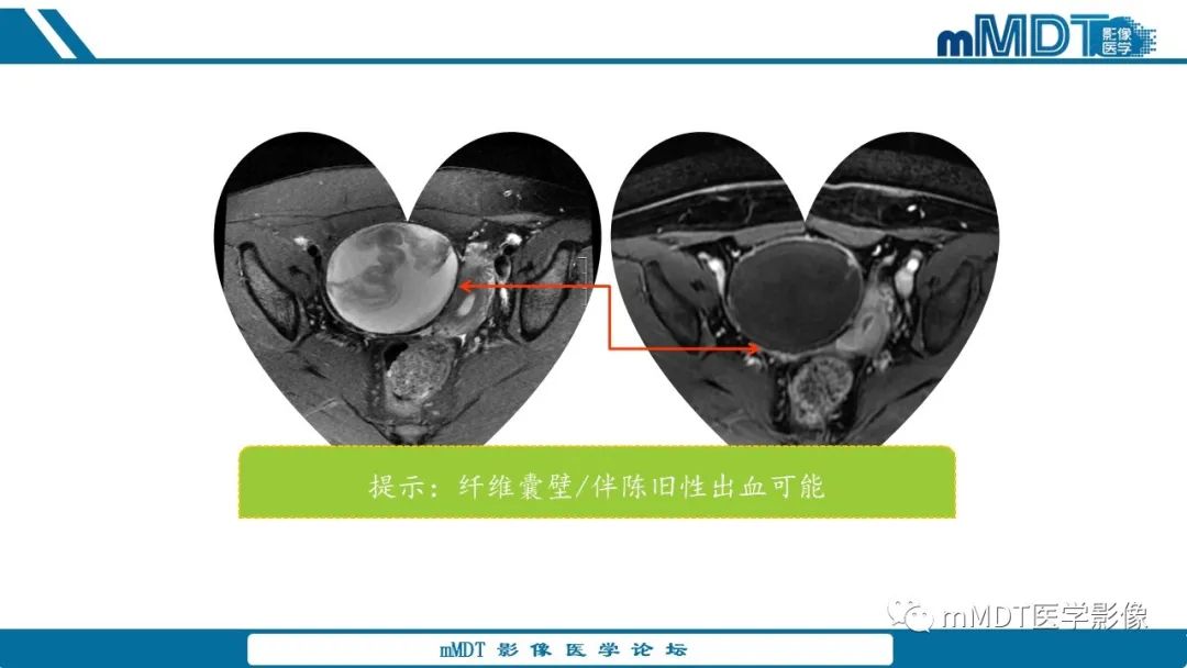 影像PPT - 【病例】盆腔纱布瘤1例MR影像解析-18