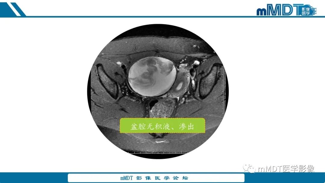 影像PPT - 【病例】盆腔纱布瘤1例MR影像解析-19