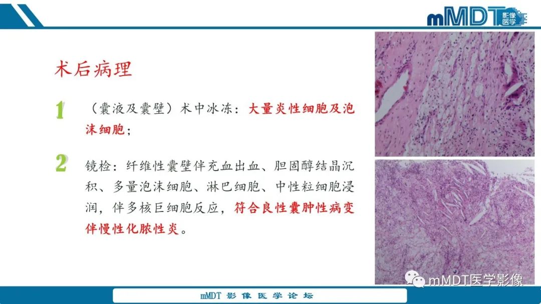 影像PPT - 【病例】盆腔纱布瘤1例MR影像解析-25