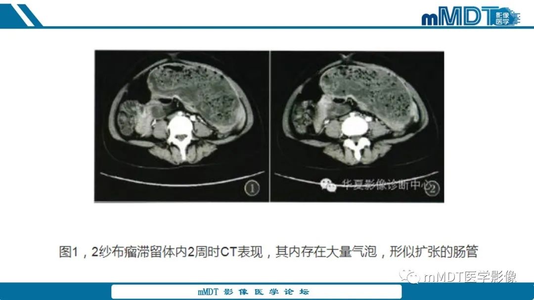 影像PPT - 【病例】盆腔纱布瘤1例MR影像解析-40
