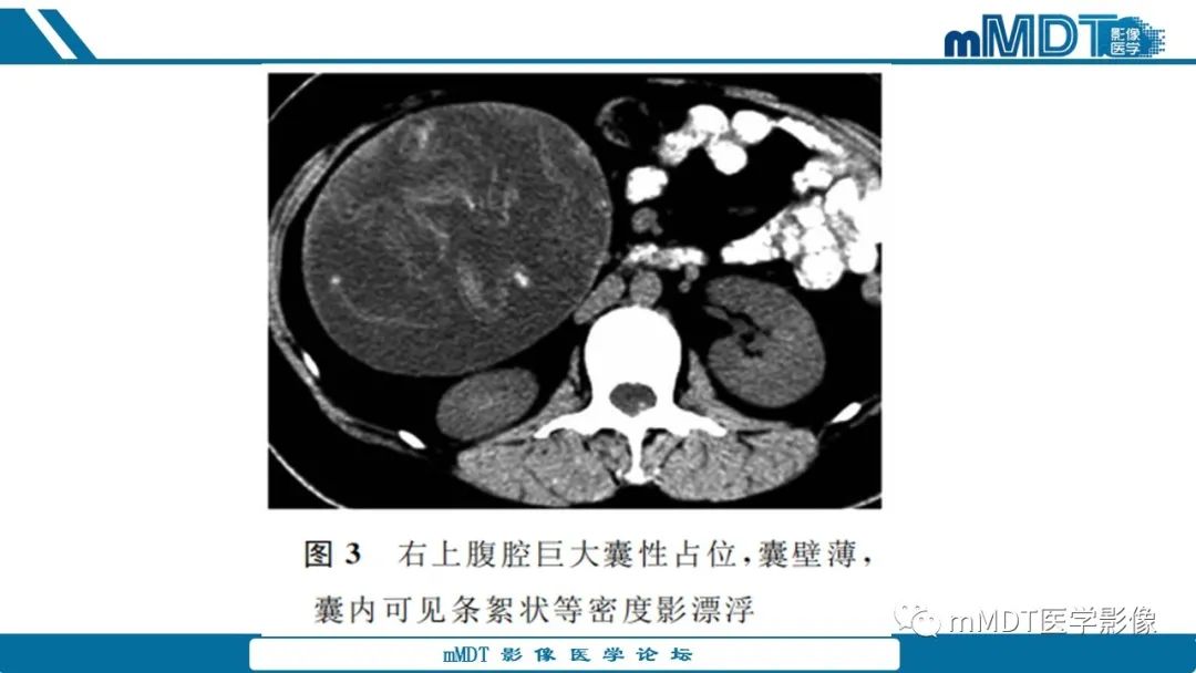 影像PPT - 【病例】盆腔纱布瘤1例MR影像解析-41