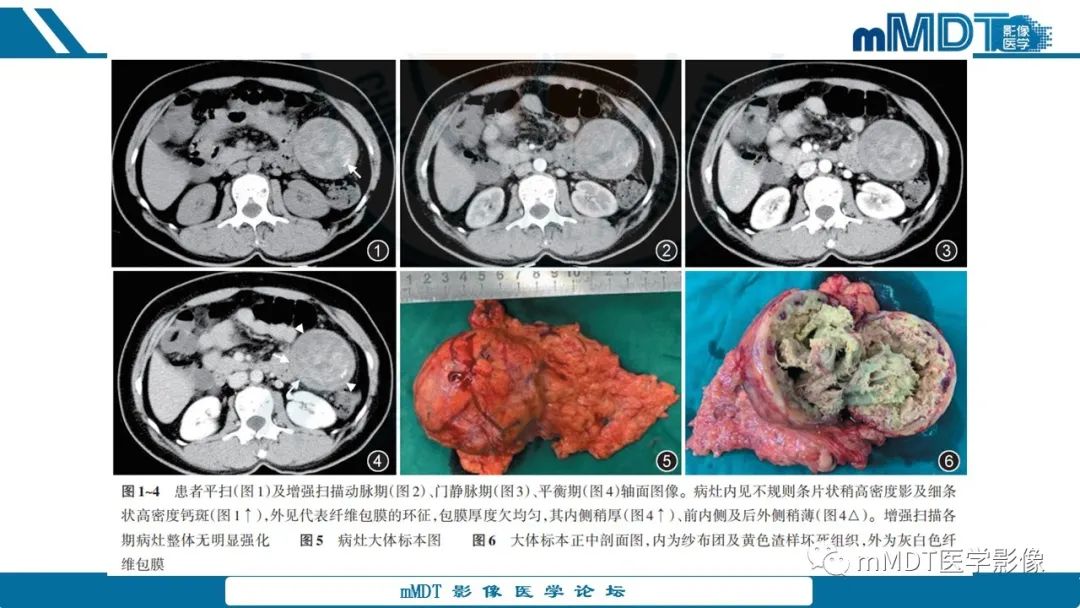 影像PPT - 【病例】盆腔纱布瘤1例MR影像解析-43