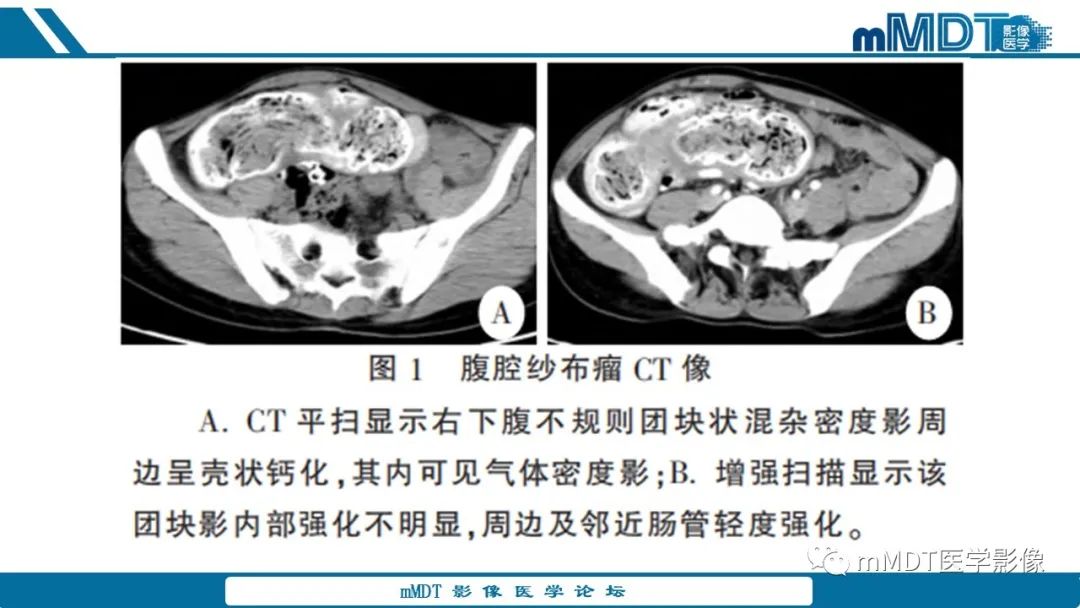 影像PPT - 【病例】盆腔纱布瘤1例MR影像解析-44