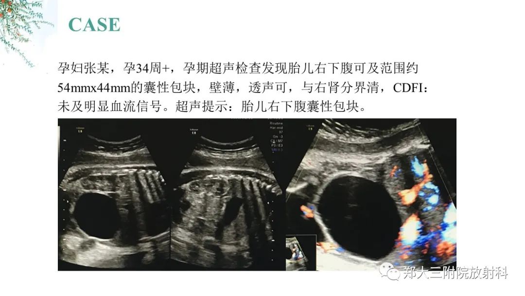 影像PPT - 【PPT】卵巢囊肿伴蒂扭转-2