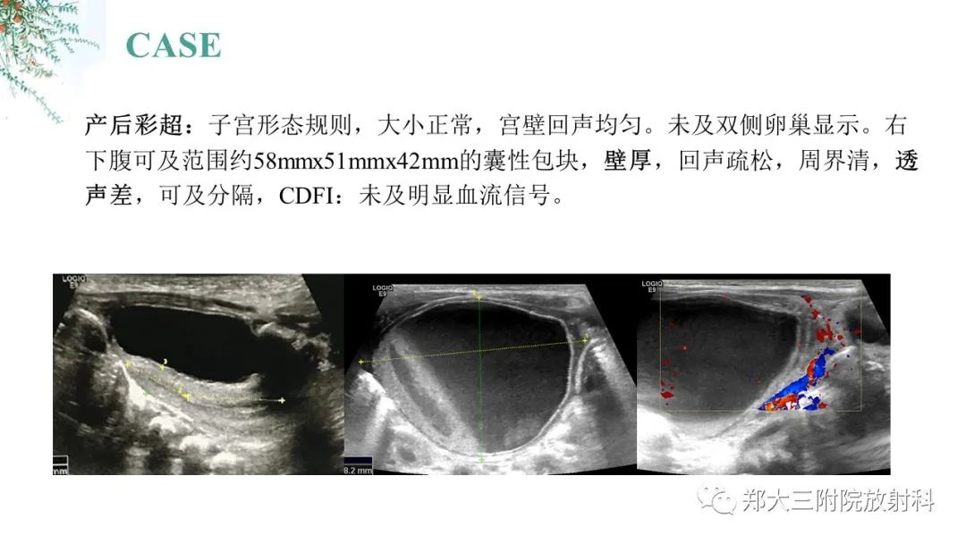 影像PPT - 【PPT】卵巢囊肿伴蒂扭转-4