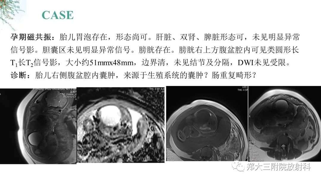 影像PPT - 【PPT】卵巢囊肿伴蒂扭转-3