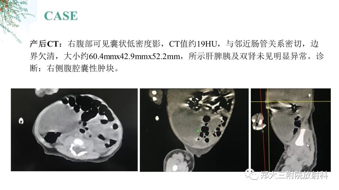 影像PPT - 【PPT】卵巢囊肿伴蒂扭转-6
