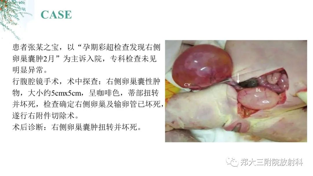影像PPT - 【PPT】卵巢囊肿伴蒂扭转-8