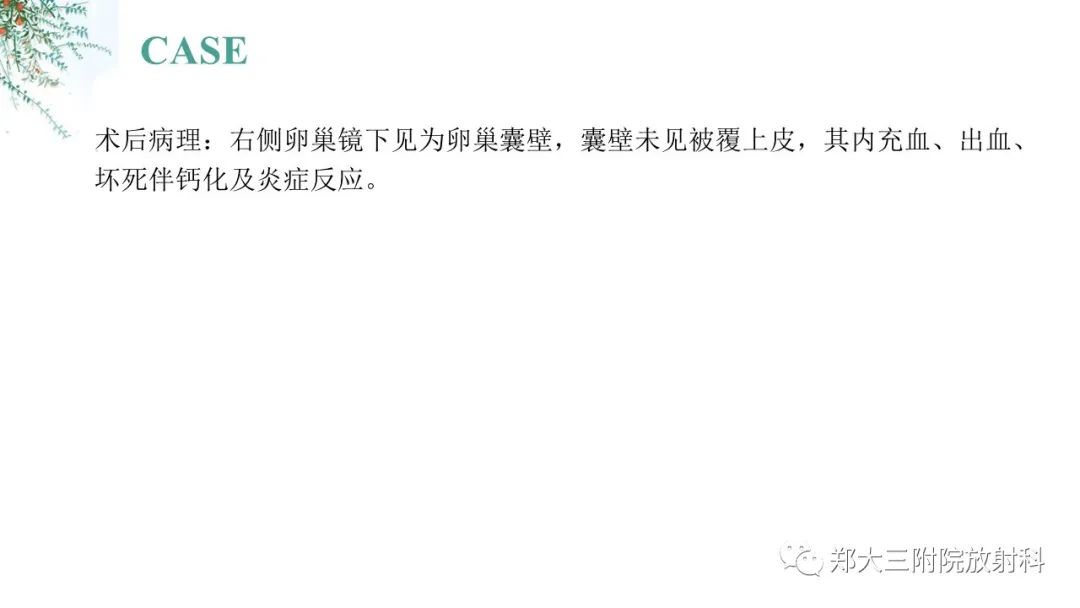 影像PPT - 【PPT】卵巢囊肿伴蒂扭转-9