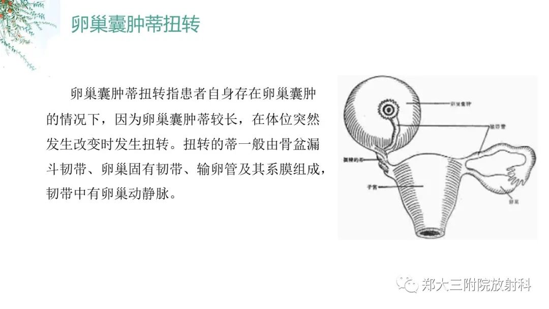 影像PPT - 【PPT】卵巢囊肿伴蒂扭转-13