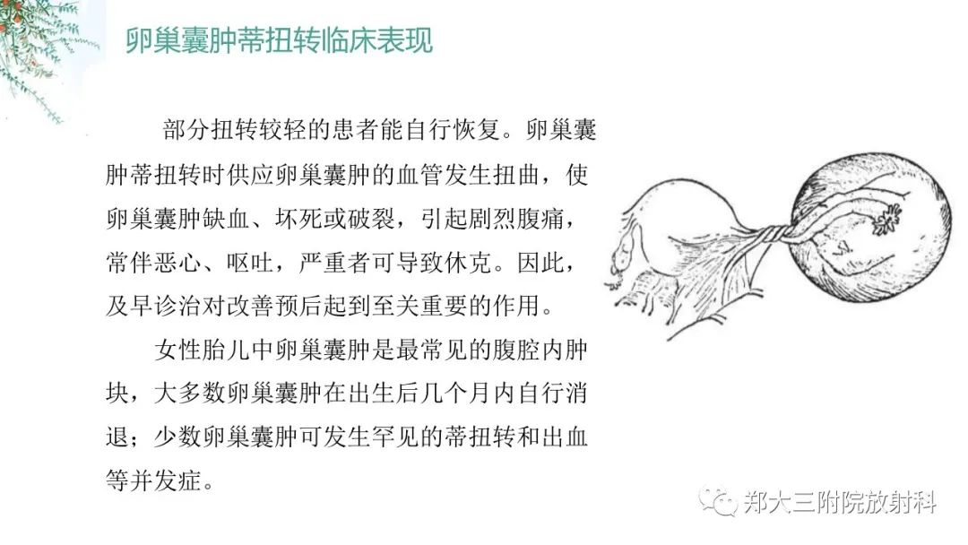 影像PPT - 【PPT】卵巢囊肿伴蒂扭转-14