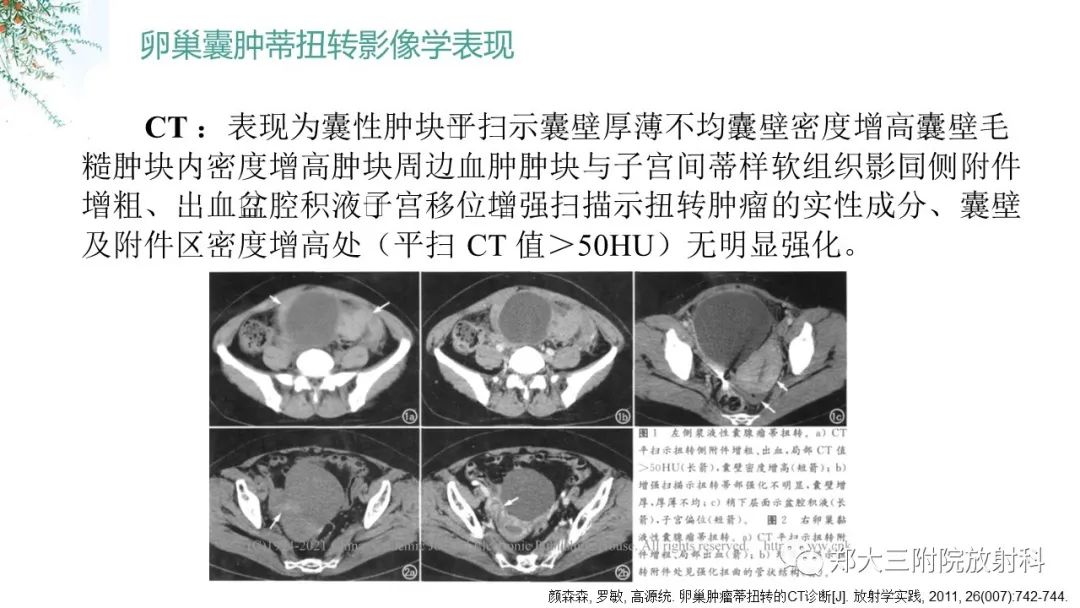 影像PPT - 【PPT】卵巢囊肿伴蒂扭转-18