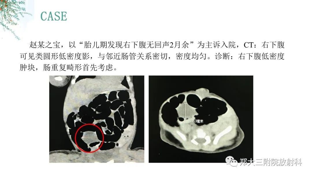 影像PPT - 【PPT】卵巢囊肿伴蒂扭转-22