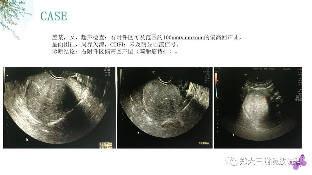 影像PPT - 【PPT】卵巢囊肿伴蒂扭转-24