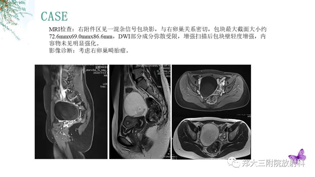 影像PPT - 【PPT】卵巢囊肿伴蒂扭转-25