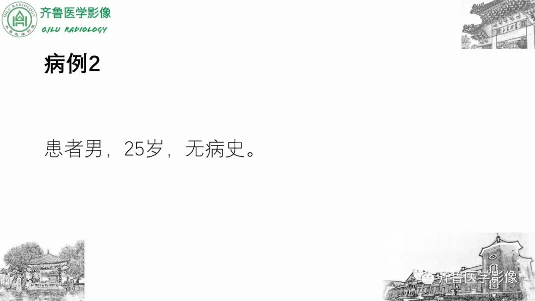 影像PPT - 【PPT】腹部血管压迫综合征-6