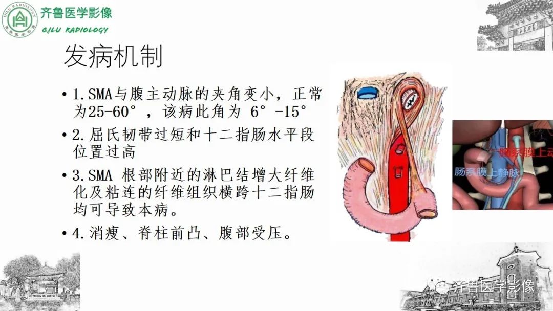 影像PPT - 【PPT】腹部血管压迫综合征-16