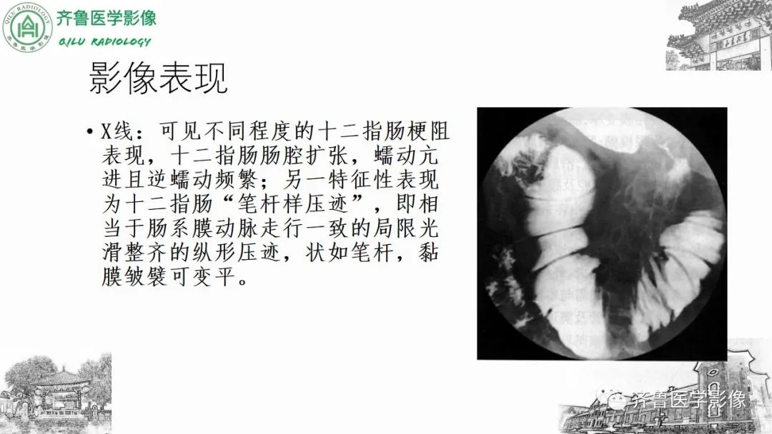 影像PPT - 【PPT】腹部血管压迫综合征-17