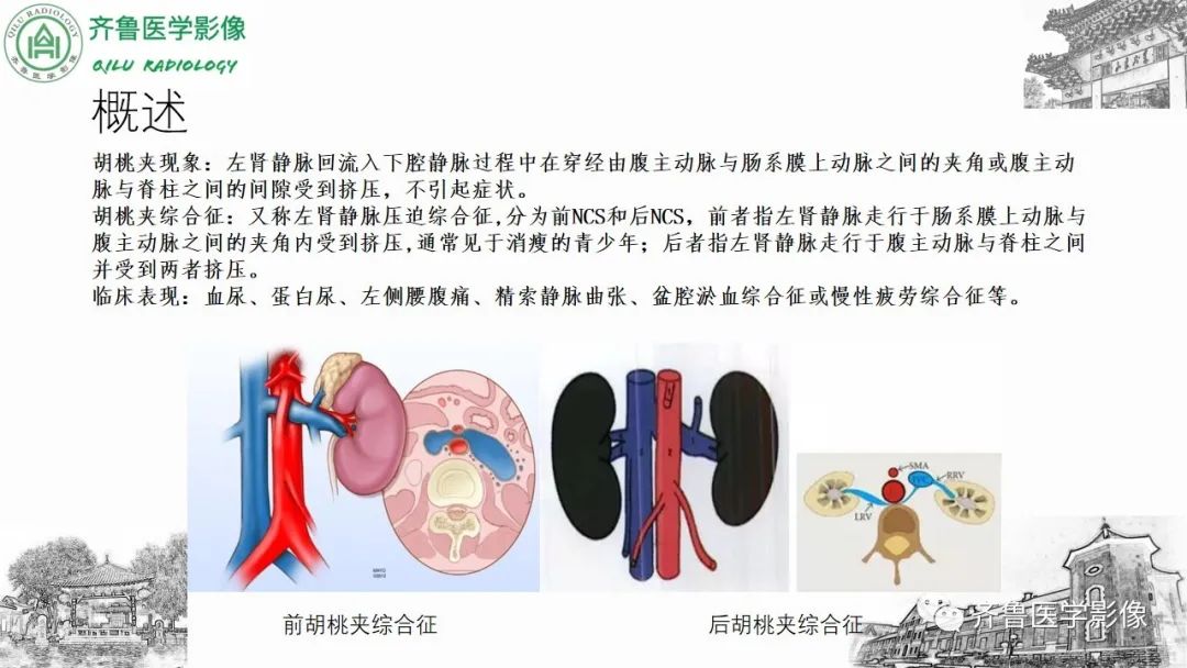 影像PPT - 【PPT】腹部血管压迫综合征-20