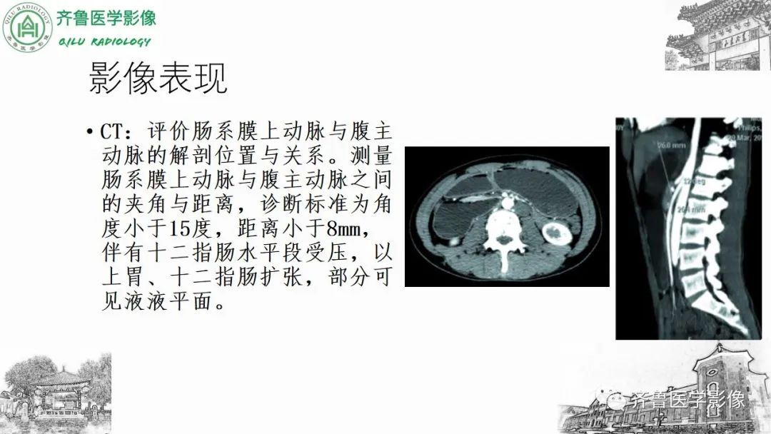影像PPT - 【PPT】腹部血管压迫综合征-18