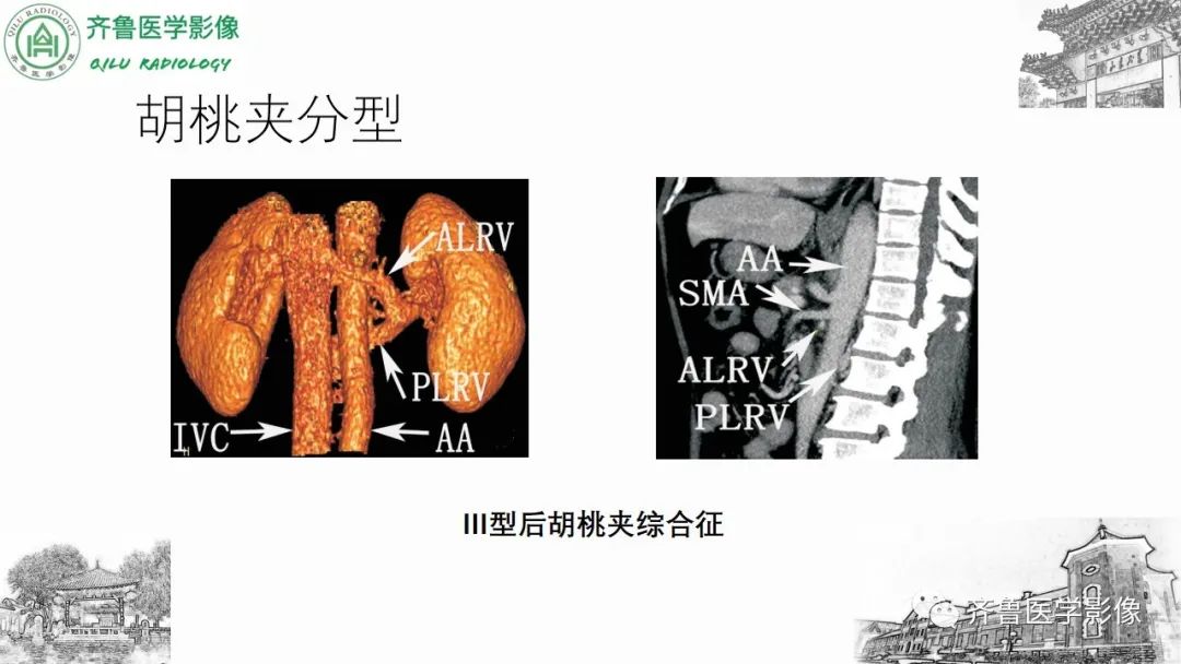 影像PPT - 【PPT】腹部血管压迫综合征-26
