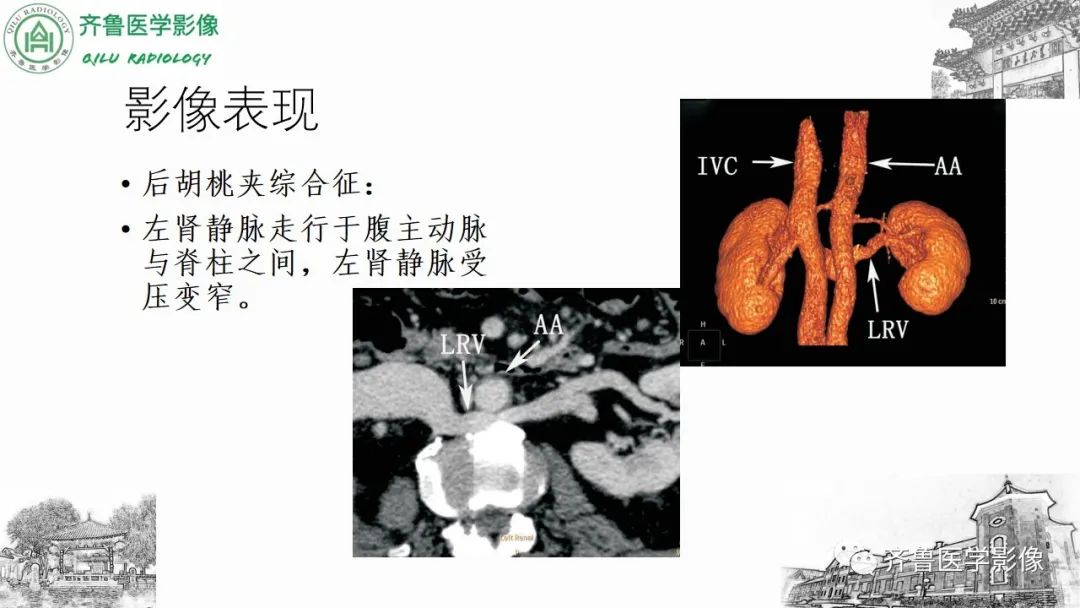 影像PPT - 【PPT】腹部血管压迫综合征-23
