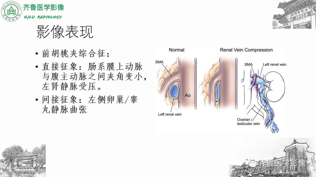 影像PPT - 【PPT】腹部血管压迫综合征-22