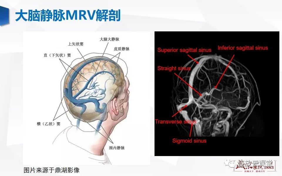 影像PPT - 【PPT】MRV在诊断静脉窦血栓中的作用-3