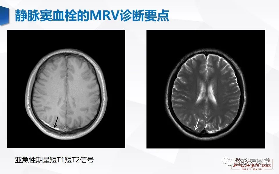 影像PPT - 【PPT】MRV在诊断静脉窦血栓中的作用-13