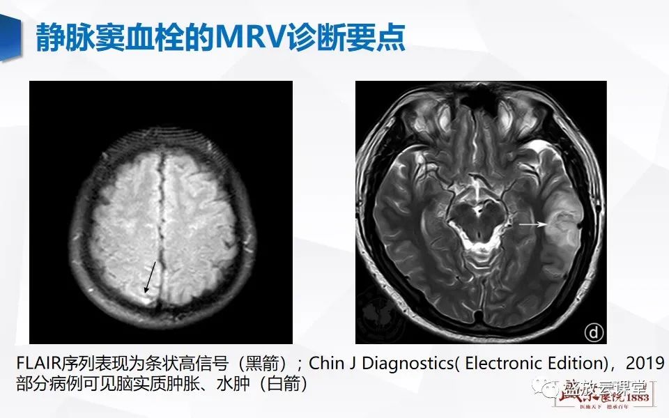 影像PPT - 【PPT】MRV在诊断静脉窦血栓中的作用-14
