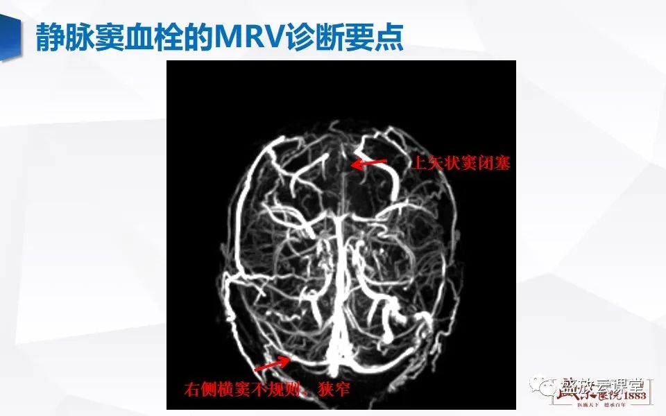 影像PPT - 【PPT】MRV在诊断静脉窦血栓中的作用-16