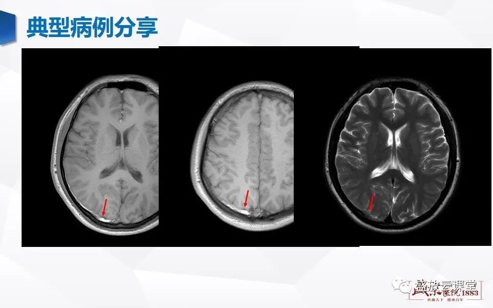 影像PPT - 【PPT】MRV在诊断静脉窦血栓中的作用-19