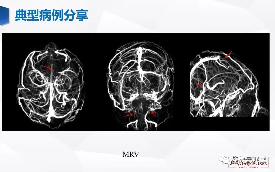 影像PPT - 【PPT】MRV在诊断静脉窦血栓中的作用-20