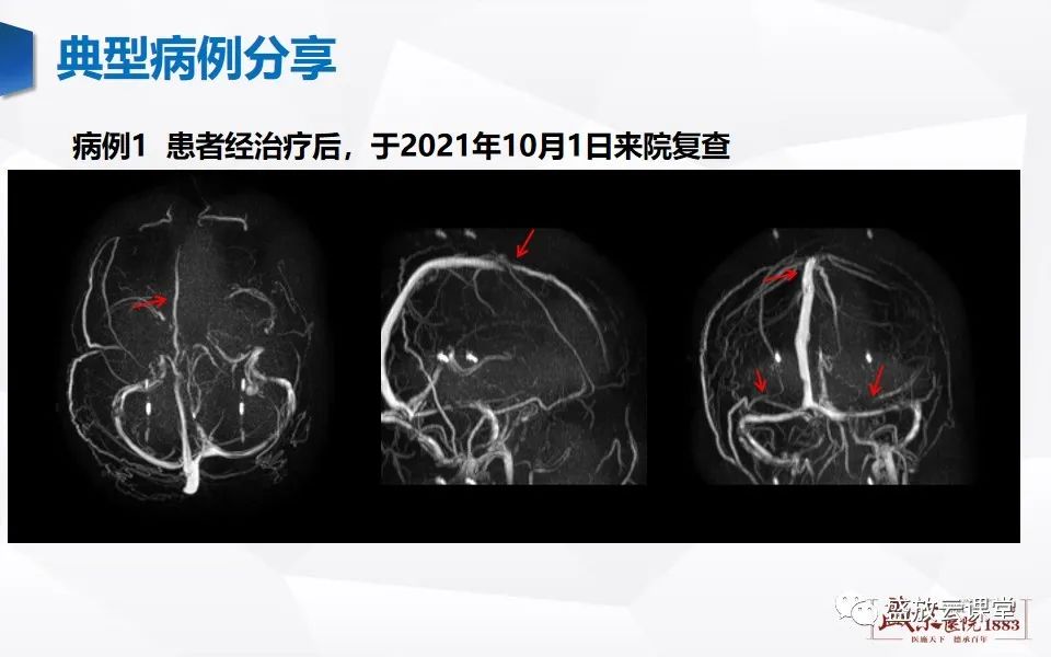 影像PPT - 【PPT】MRV在诊断静脉窦血栓中的作用-22