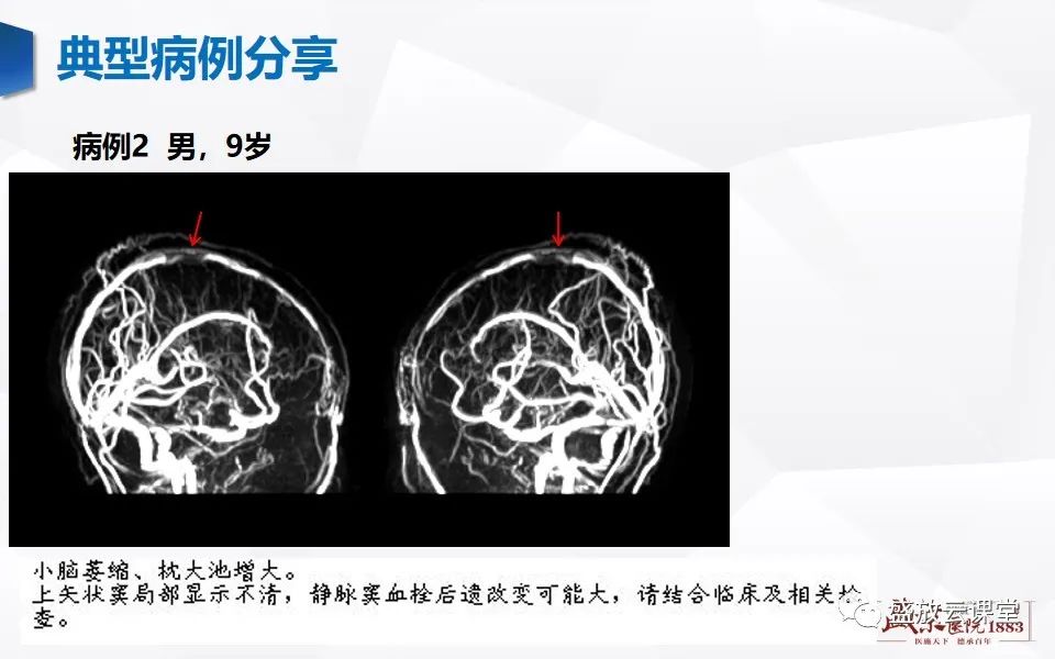 影像PPT - 【PPT】MRV在诊断静脉窦血栓中的作用-23