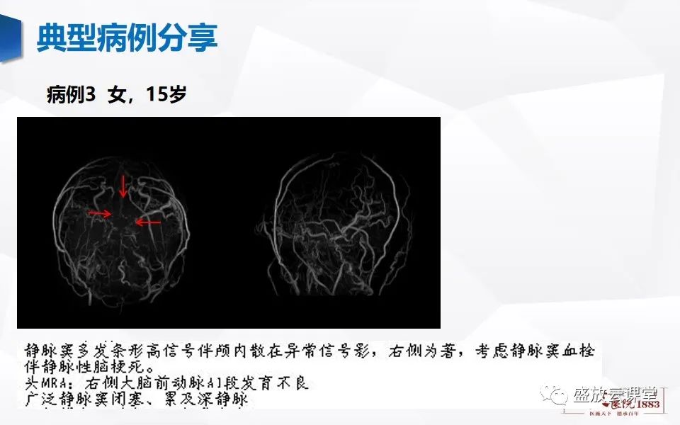 影像PPT - 【PPT】MRV在诊断静脉窦血栓中的作用-24