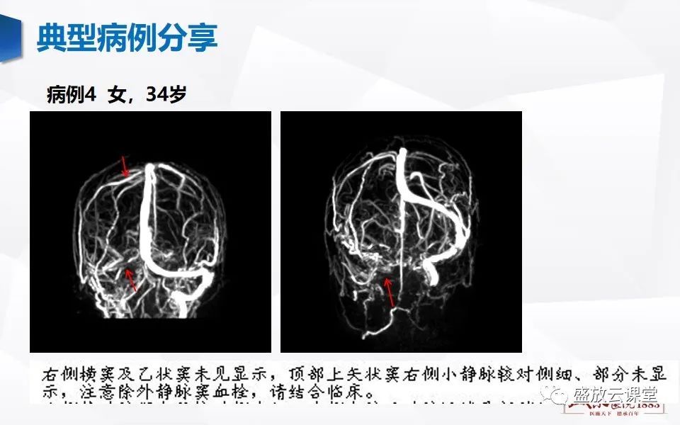 影像PPT - 【PPT】MRV在诊断静脉窦血栓中的作用-25