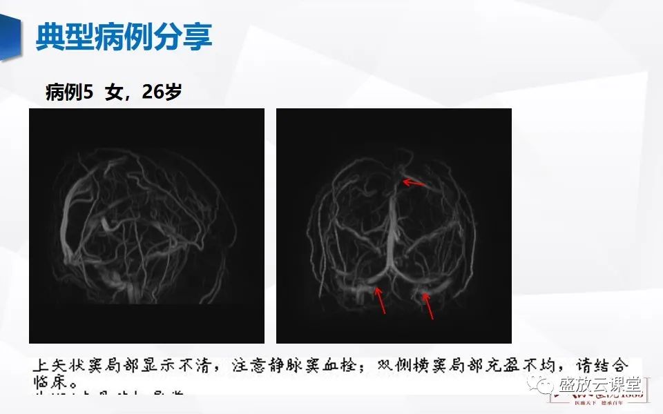影像PPT - 【PPT】MRV在诊断静脉窦血栓中的作用-26