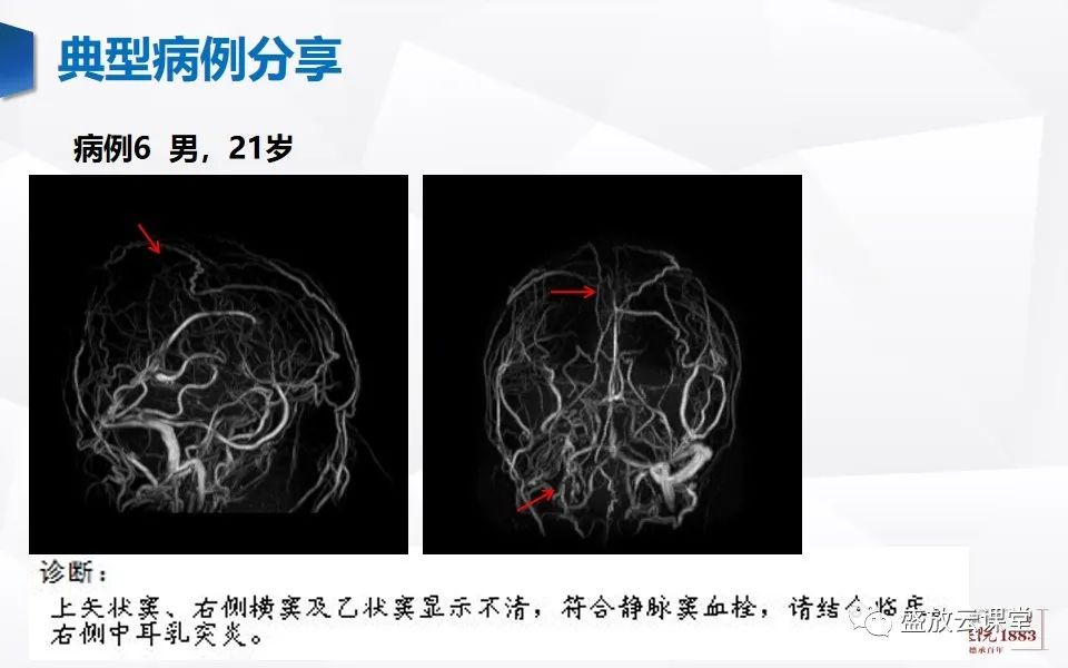 影像PPT - 【PPT】MRV在诊断静脉窦血栓中的作用-27