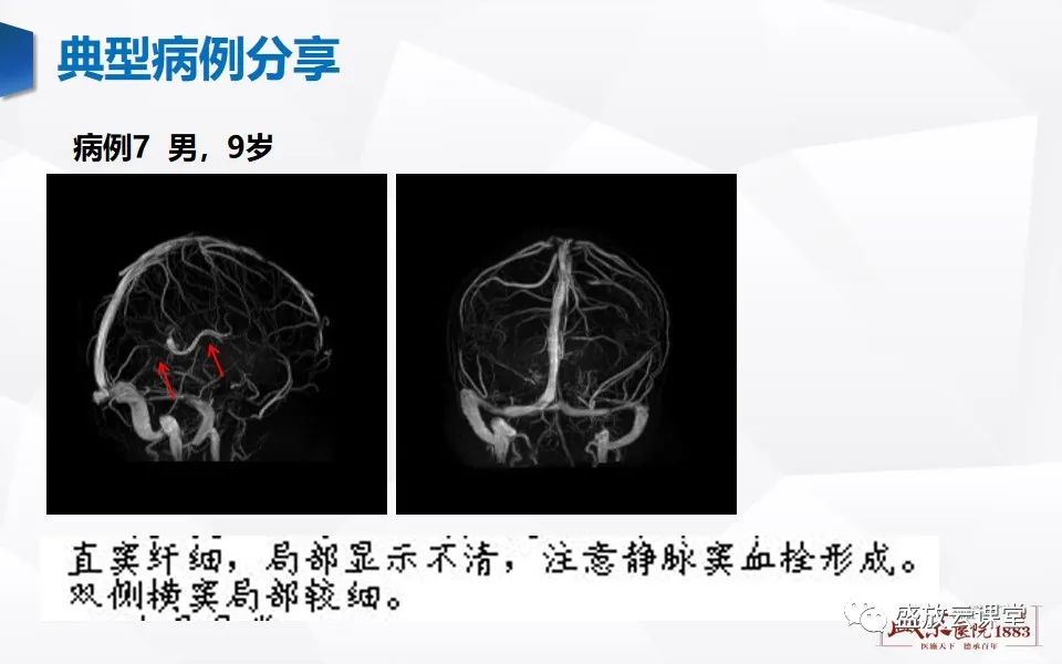 影像PPT - 【PPT】MRV在诊断静脉窦血栓中的作用-28