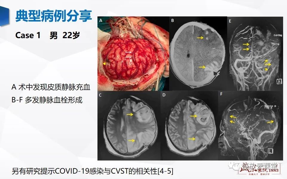 影像PPT - 【PPT】MRV在诊断静脉窦血栓中的作用-30