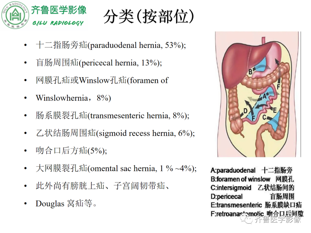 影像PPT - 【PPT】腹内疝-24
