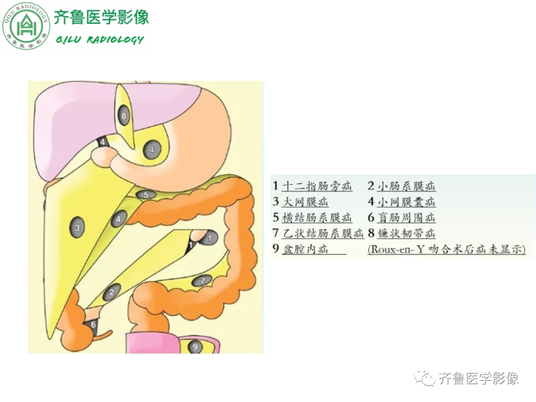 影像PPT - 【PPT】腹内疝-25
