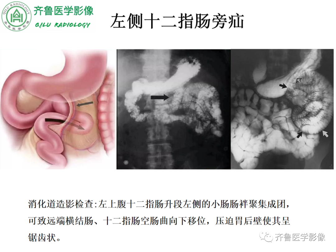 影像PPT - 【PPT】腹内疝-30