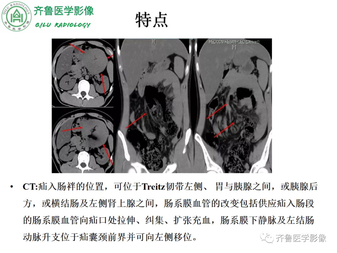 影像PPT - 【PPT】腹内疝-31